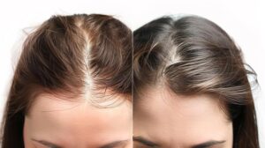 Hair Transplantation